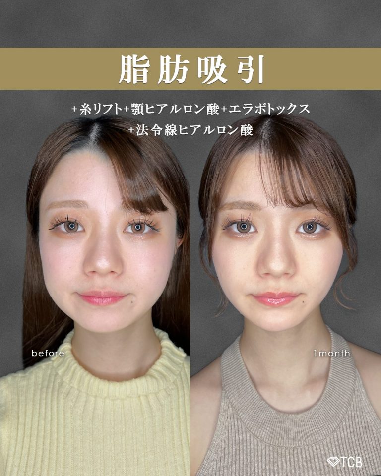 顔の脂肪吸引(担当医:富田 秀鷹 医師)の症例写真1