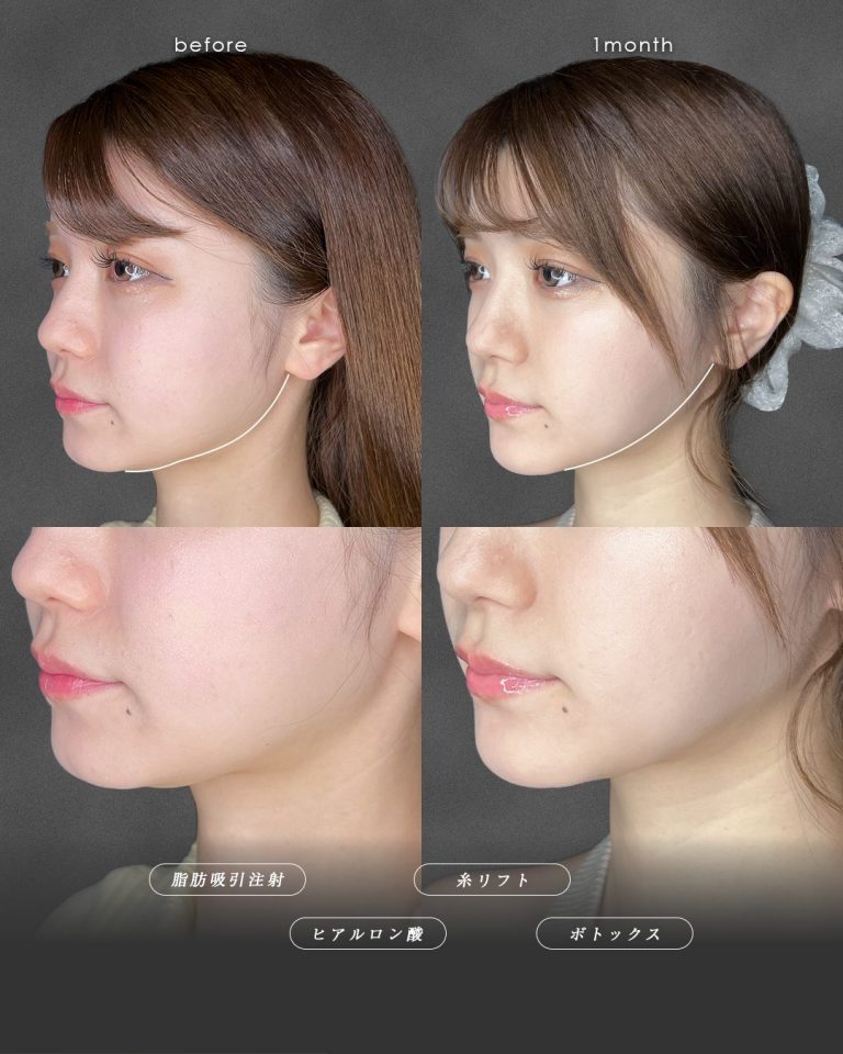 顔の脂肪吸引(担当医:富田 秀鷹 医師)の症例写真2