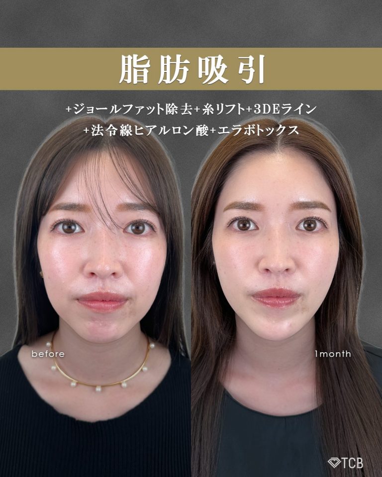 顔の脂肪吸引(担当医:富田 秀鷹 医師)の症例写真1