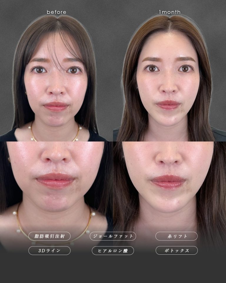 顔の脂肪吸引(担当医:富田 秀鷹 医師)の症例写真2