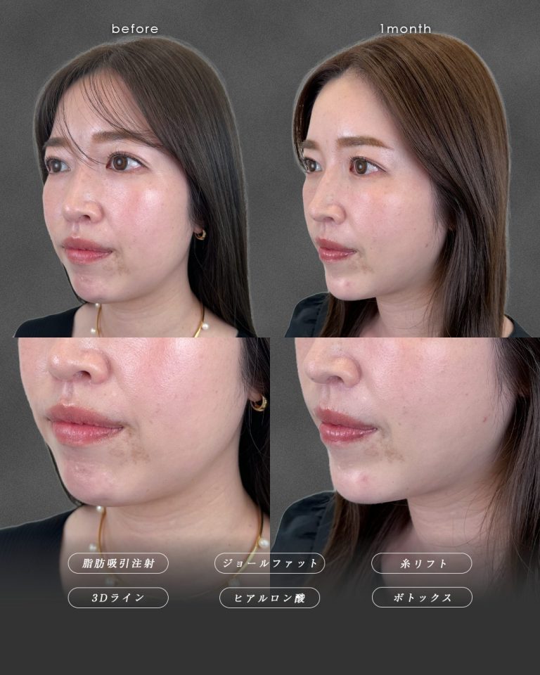 顔の脂肪吸引(担当医:富田 秀鷹 医師)の症例写真3