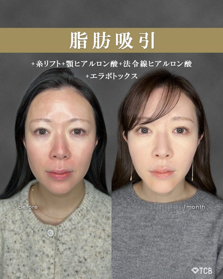 顔の脂肪吸引(担当医:富田 秀鷹 医師)の症例写真1