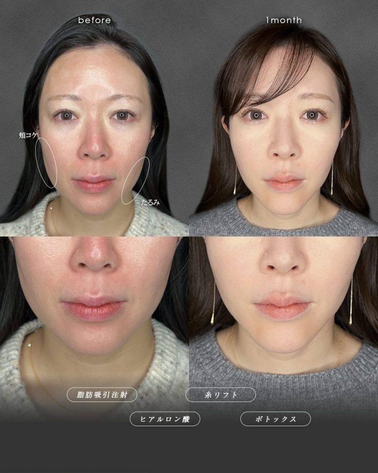 顔の脂肪吸引(担当医:富田 秀鷹 医師)の症例写真2