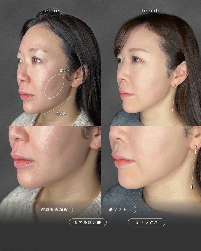 顔の脂肪吸引(担当医:富田 秀鷹 医師)の症例写真3