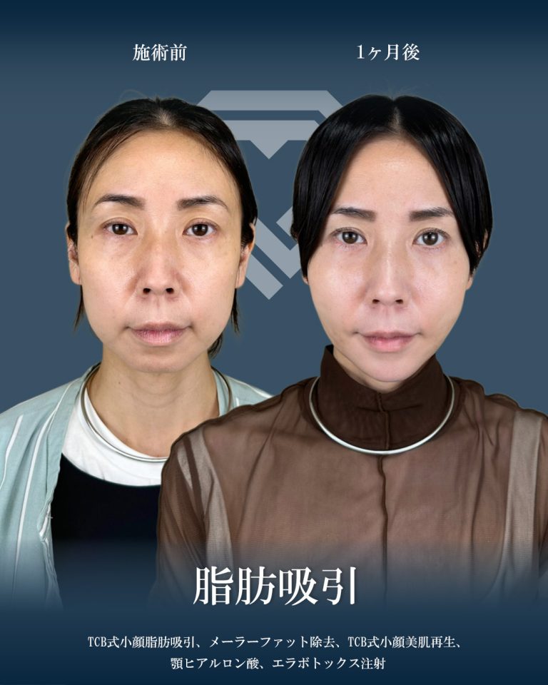 顔の脂肪吸引(担当医:大見 貴秀 医師)の症例写真1