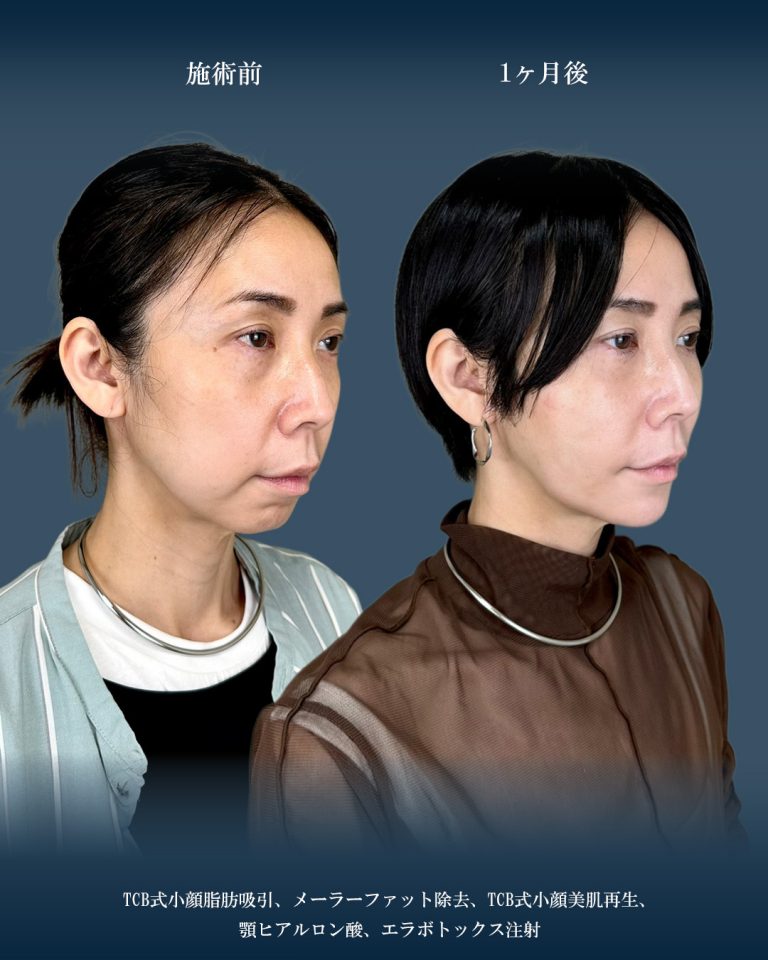 顔の脂肪吸引(担当医:大見 貴秀 医師)の症例写真2