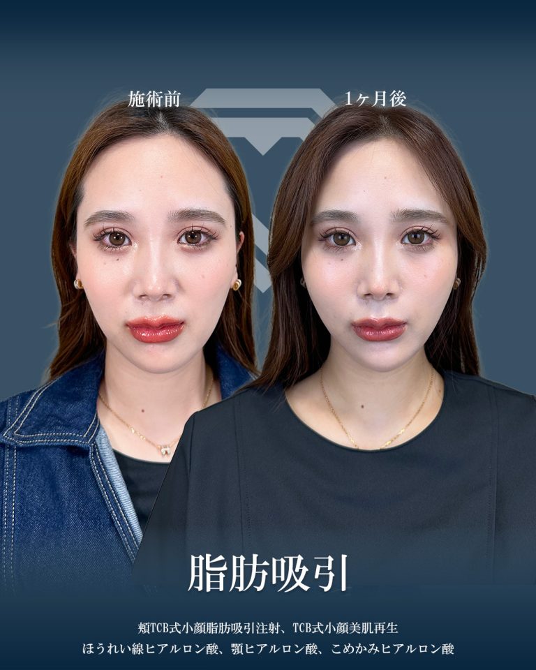 ジョールファット除去(担当医:大見 貴秀 医師)の症例写真1