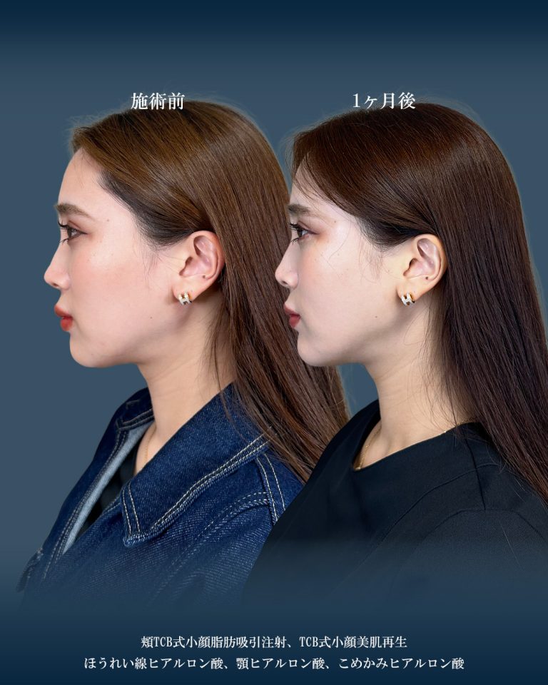 ジョールファット除去(担当医:大見 貴秀 医師)の症例写真2