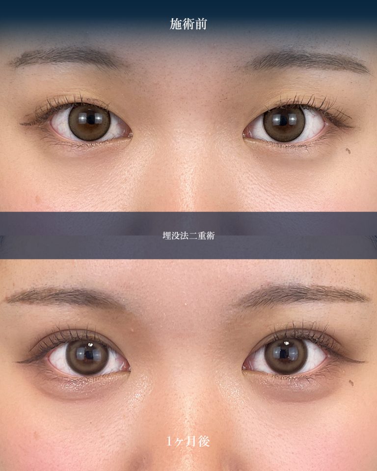 二重埋没法(担当医:大見 貴秀 医師)の症例写真1