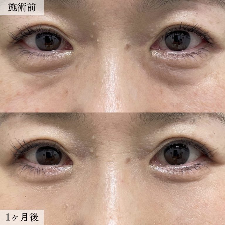 切らない目の下のクマ取り・目の下のたるみ（ふくらみ）取り(担当医:大見 貴秀 医師)の症例写真1