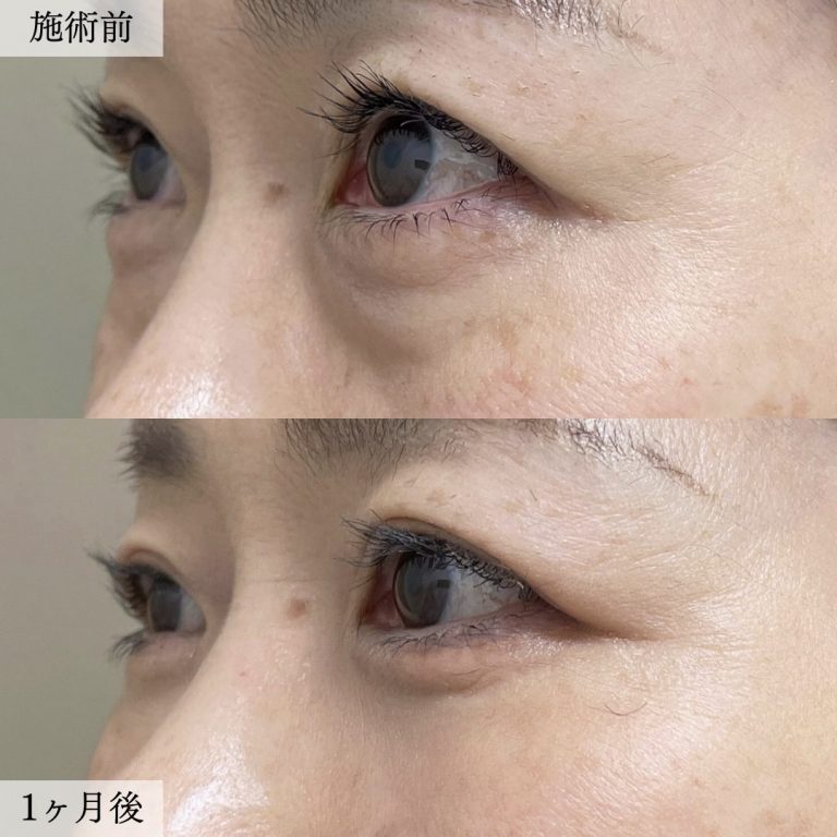 切らない目の下のクマ取り・目の下のたるみ（ふくらみ）取り(担当医:大見 貴秀 医師)の症例写真2