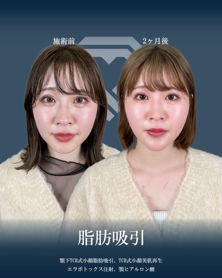 顔の脂肪吸引(担当医:大見 貴秀 医師)の症例写真1