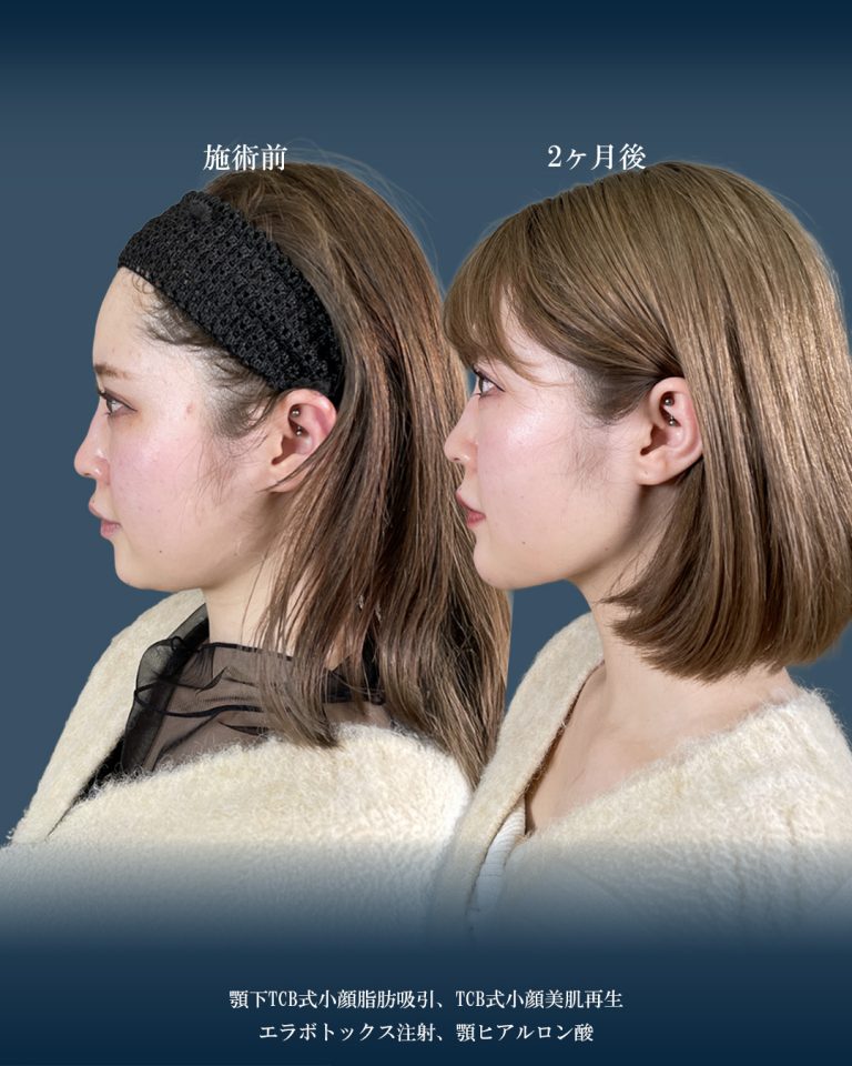 顔の脂肪吸引(担当医:大見 貴秀 医師)の症例写真2