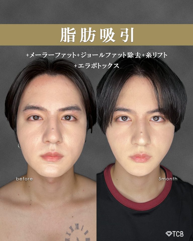 顔の脂肪吸引(担当医:富田 秀鷹 医師)の症例写真1