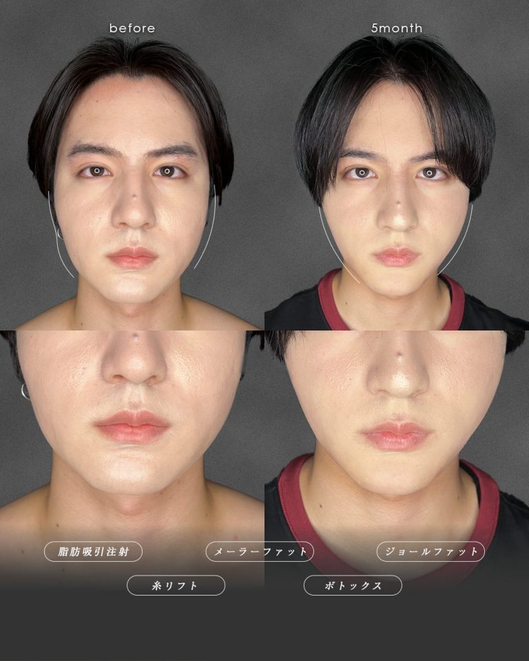 顔の脂肪吸引(担当医:富田 秀鷹 医師)の症例写真2