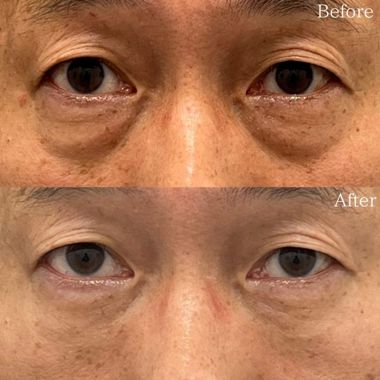 切らない目の下のクマ取り・目の下のたるみ（ふくらみ）取り(担当医:佐野 孝治 医師)の症例写真1
