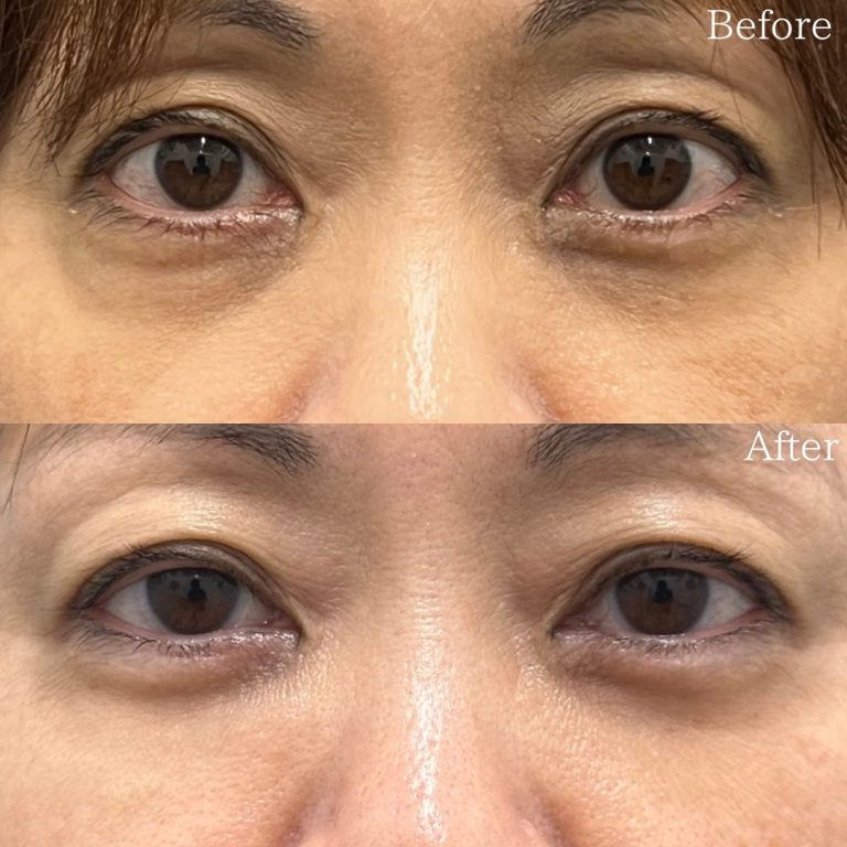 切らない目の下のクマ取り・目の下のたるみ（ふくらみ）取り(担当医:佐野 孝治 医師)の症例写真1