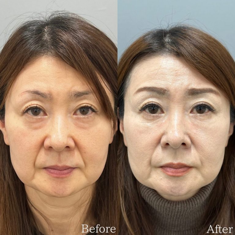 切らない目の下のクマ取り・目の下のたるみ（ふくらみ）取り(担当医:佐野 孝治 医師)の症例写真1