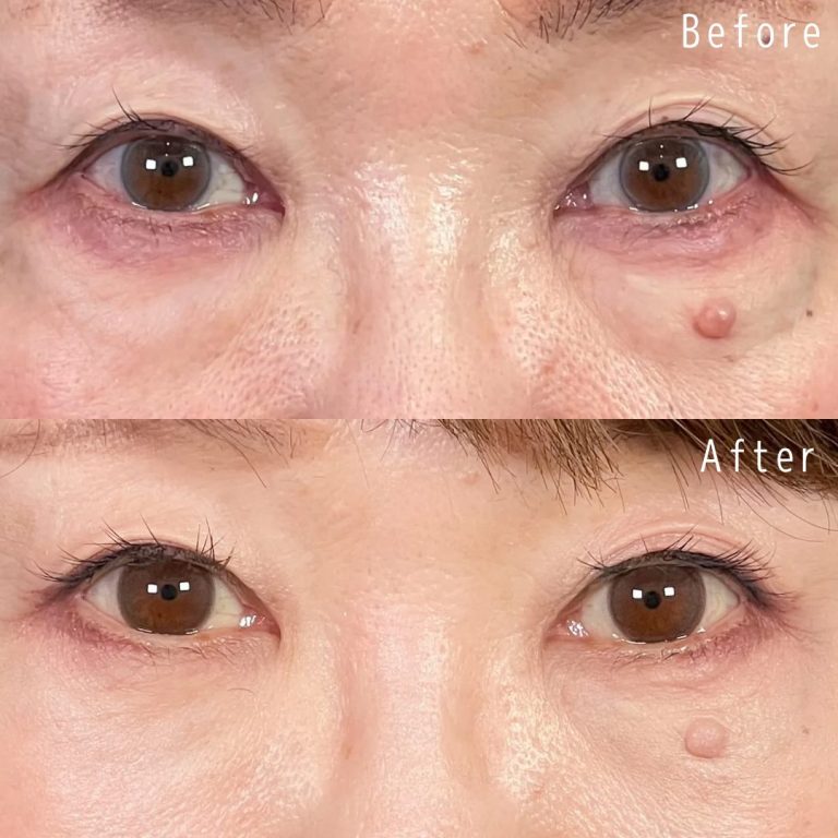 切らない目の下のクマ取り・目の下のたるみ（ふくらみ）取り(担当医:佐野 孝治 医師)の症例写真1