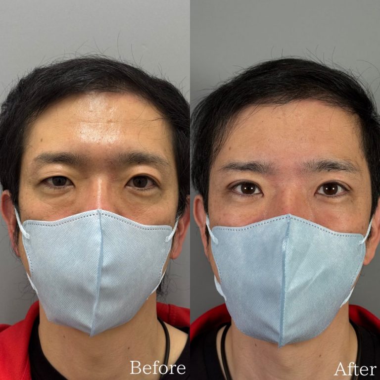 切らない目の下のクマ取り・目の下のたるみ（ふくらみ）取り(担当医:佐野 孝治 医師)の症例写真1