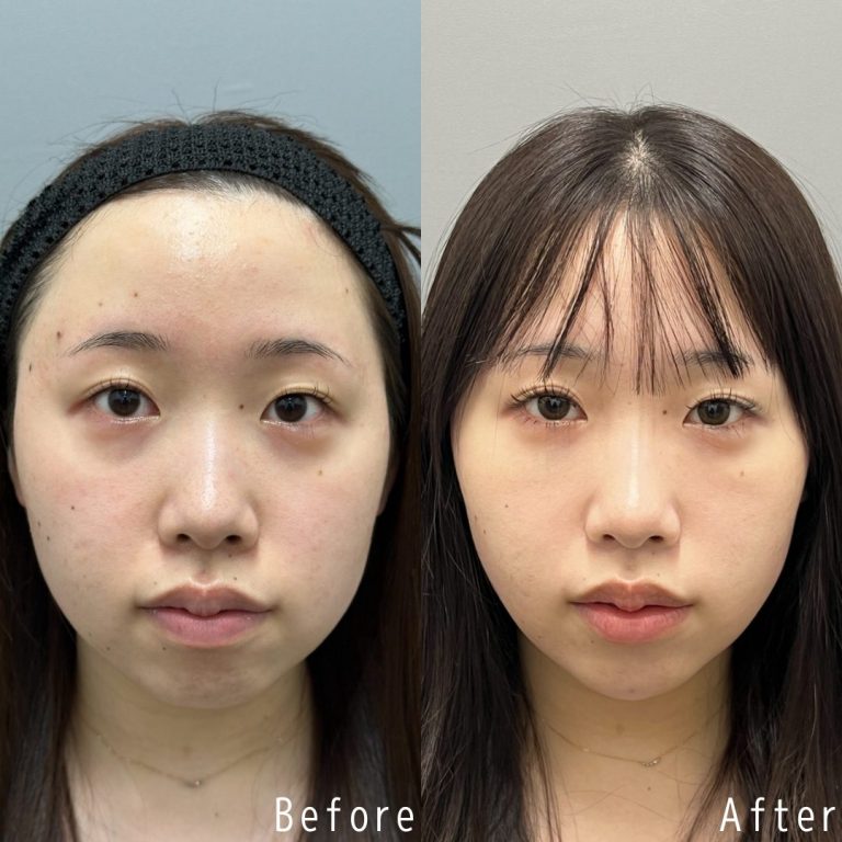 顔の脂肪吸引(担当医:佐野 孝治 医師)の症例写真2