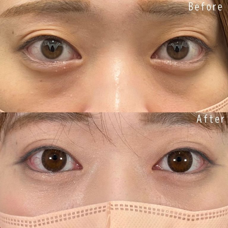 切らない目の下のクマ取り・目の下のたるみ（ふくらみ）取り(担当医:佐野 孝治 医師)の症例写真1