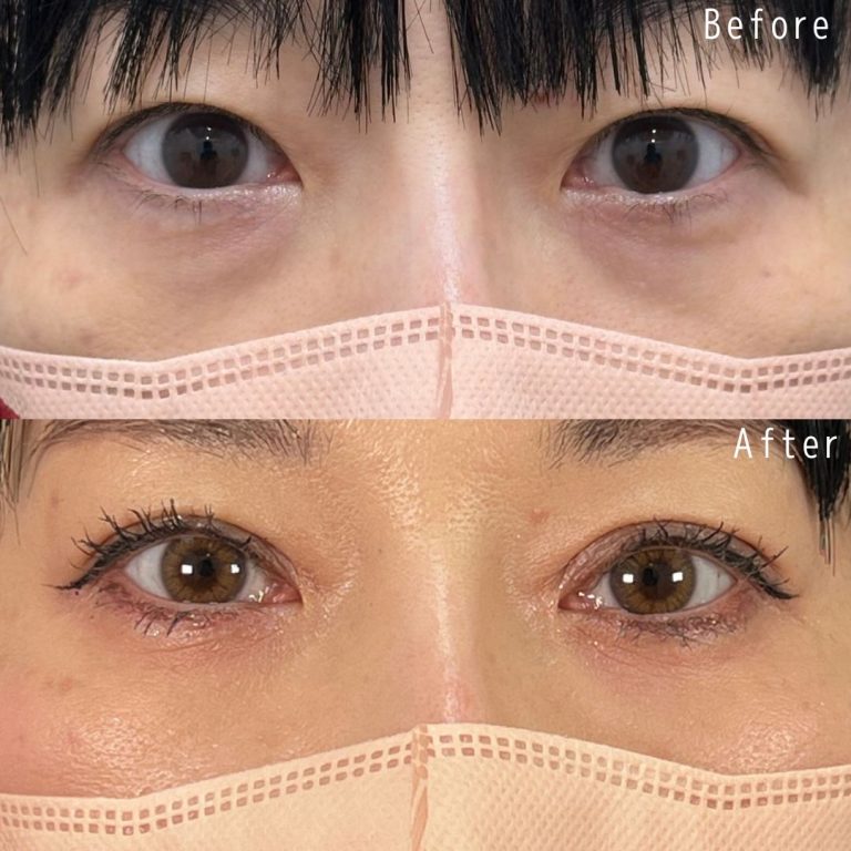 切らない目の下のクマ取り・目の下のたるみ（ふくらみ）取り(担当医:佐野 孝治 医師)の症例写真1