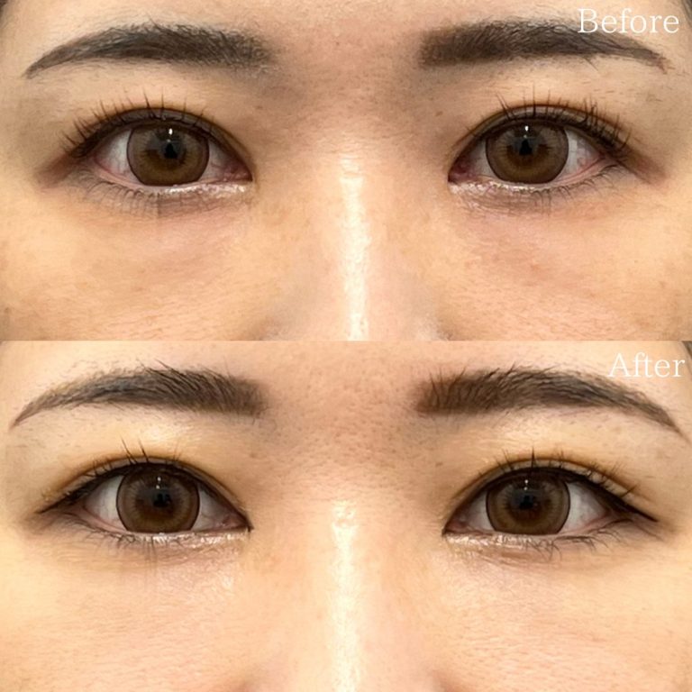 切らない目の下のクマ取り・目の下のたるみ（ふくらみ）取り(担当医:佐野 孝治 医師)の症例写真1