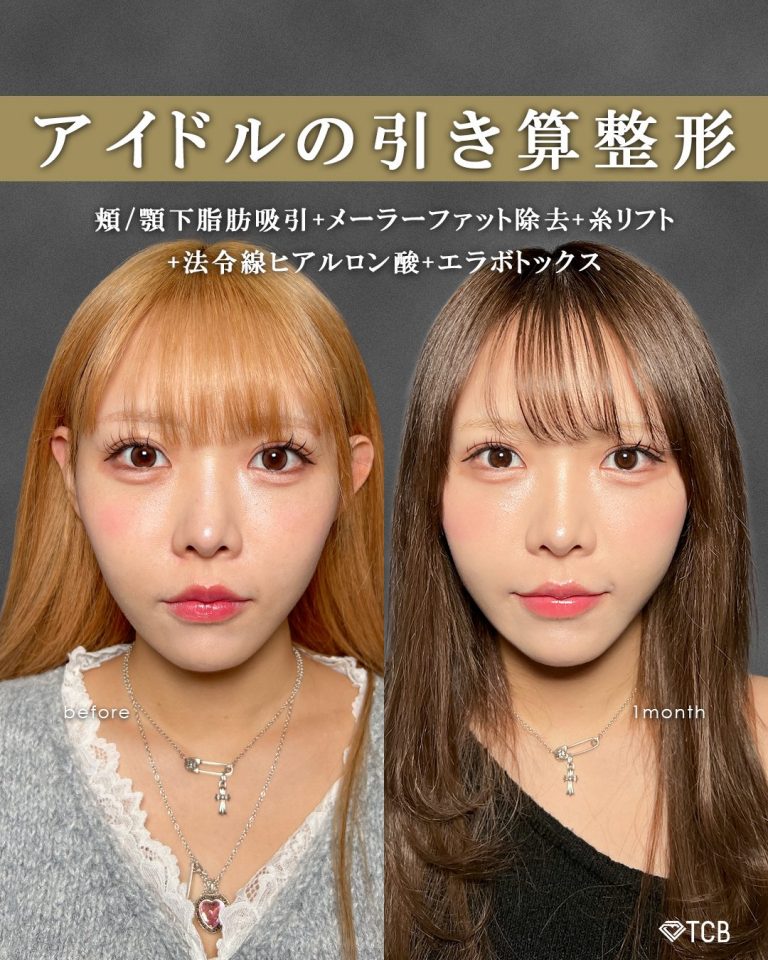 顔の脂肪吸引(担当医:富田 秀鷹 医師)の症例写真1