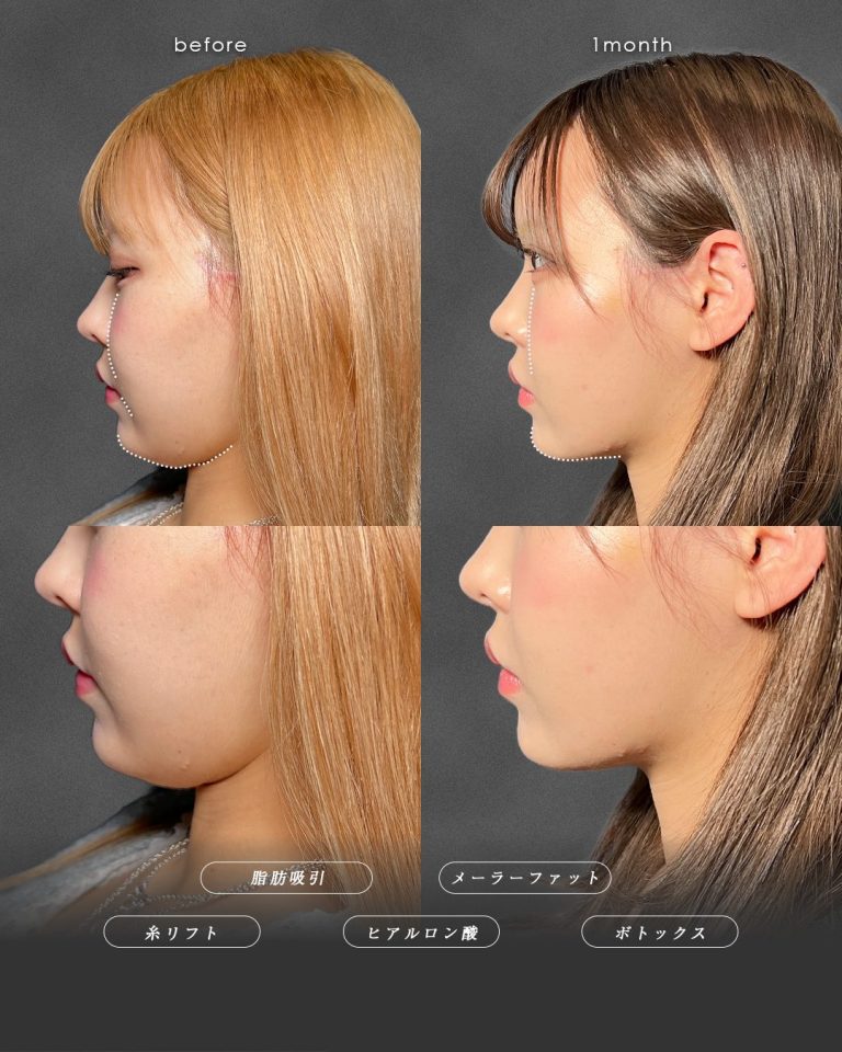 顔の脂肪吸引(担当医:富田 秀鷹 医師)の症例写真2