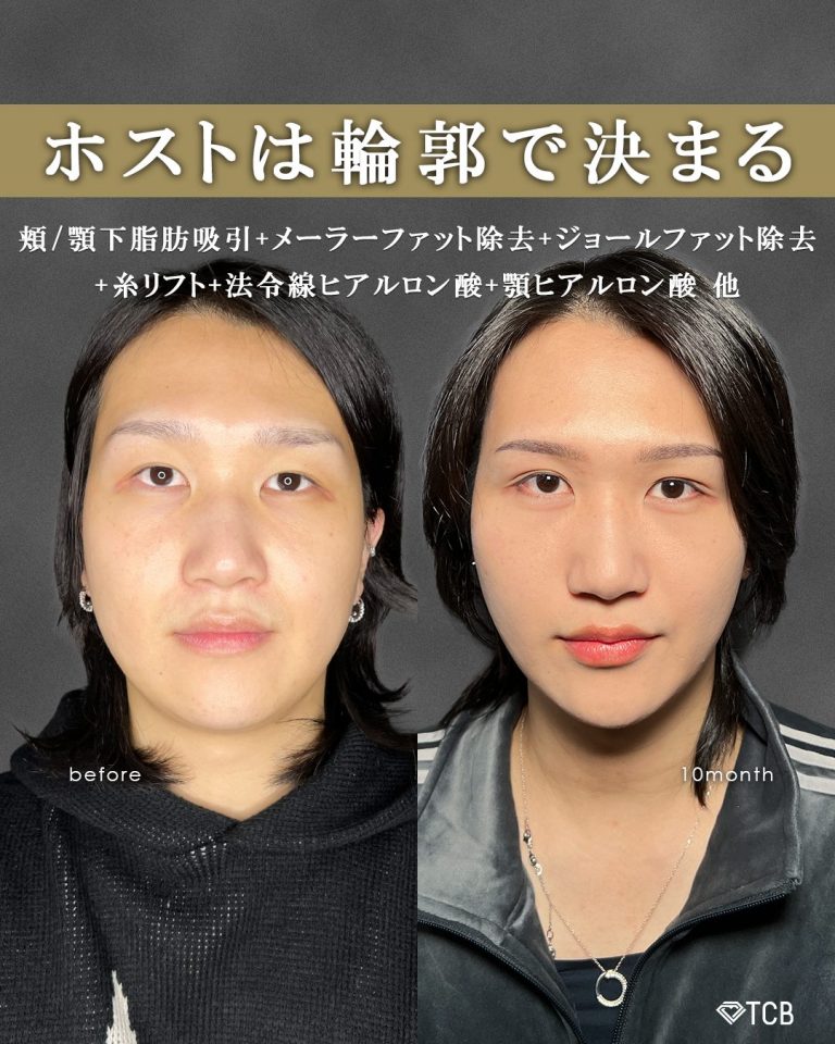 顔の脂肪吸引(担当医:富田 秀鷹 医師)の症例写真1