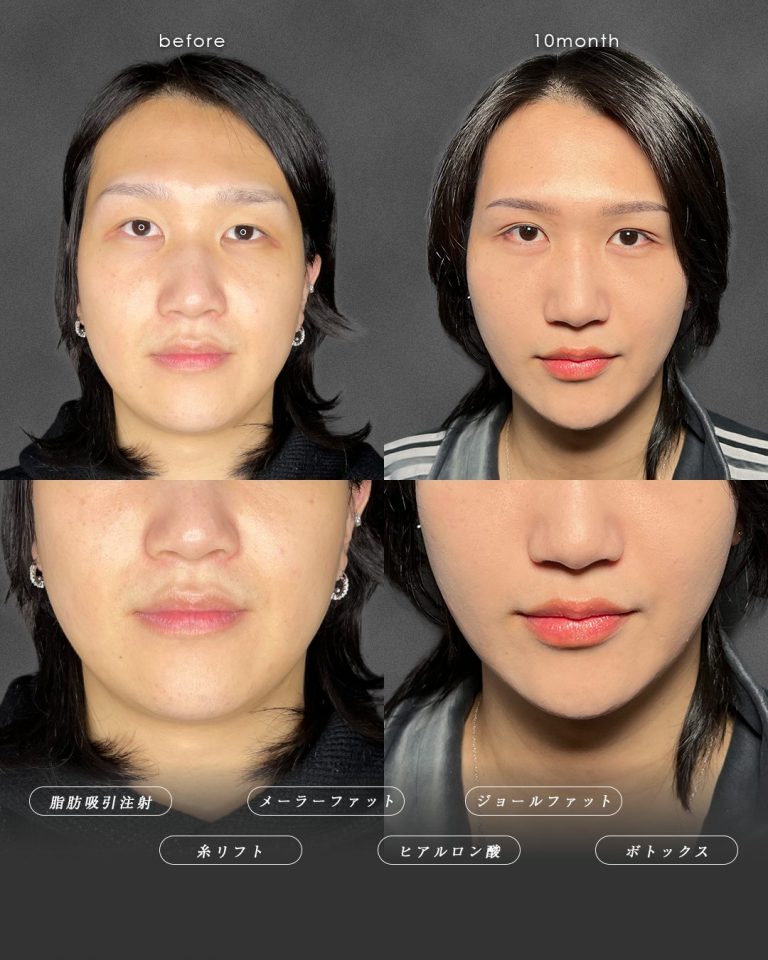 顔の脂肪吸引(担当医:富田 秀鷹 医師)の症例写真3