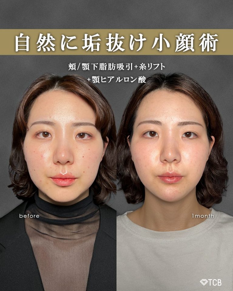 顔の脂肪吸引(担当医:富田 秀鷹 医師)の症例写真1