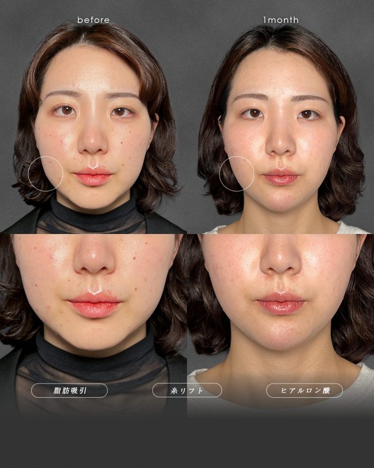 顔の脂肪吸引(担当医:富田 秀鷹 医師)の症例写真2