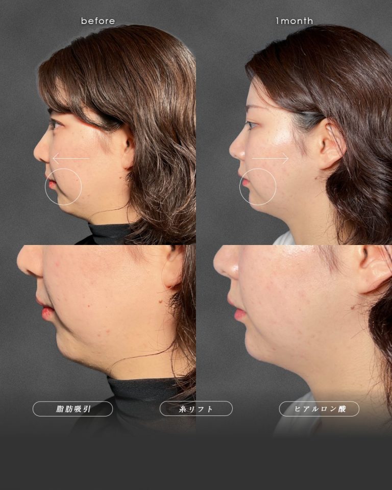 顔の脂肪吸引(担当医:富田 秀鷹 医師)の症例写真3