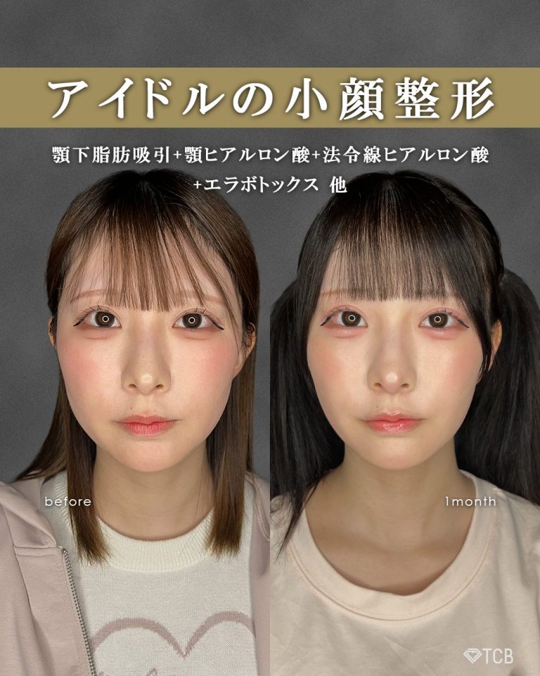 顔の脂肪吸引(担当医:富田 秀鷹 医師)の症例写真1