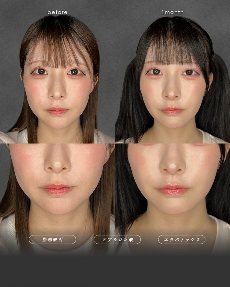 顔の脂肪吸引(担当医:富田 秀鷹 医師)の症例写真3