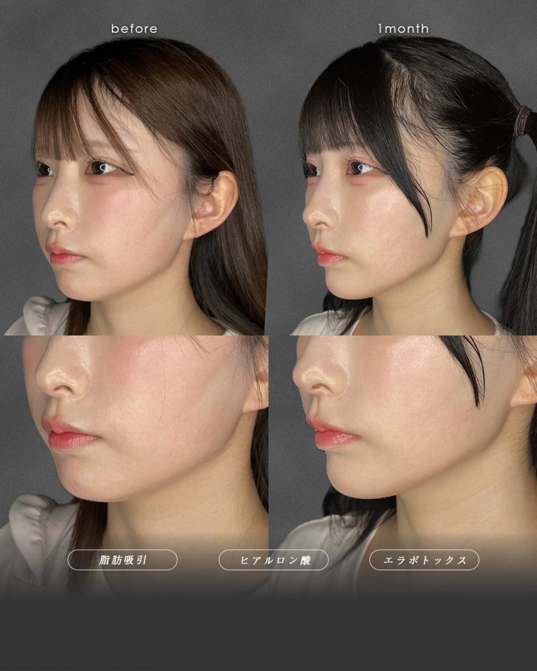 顔の脂肪吸引(担当医:富田 秀鷹 医師)の症例写真2