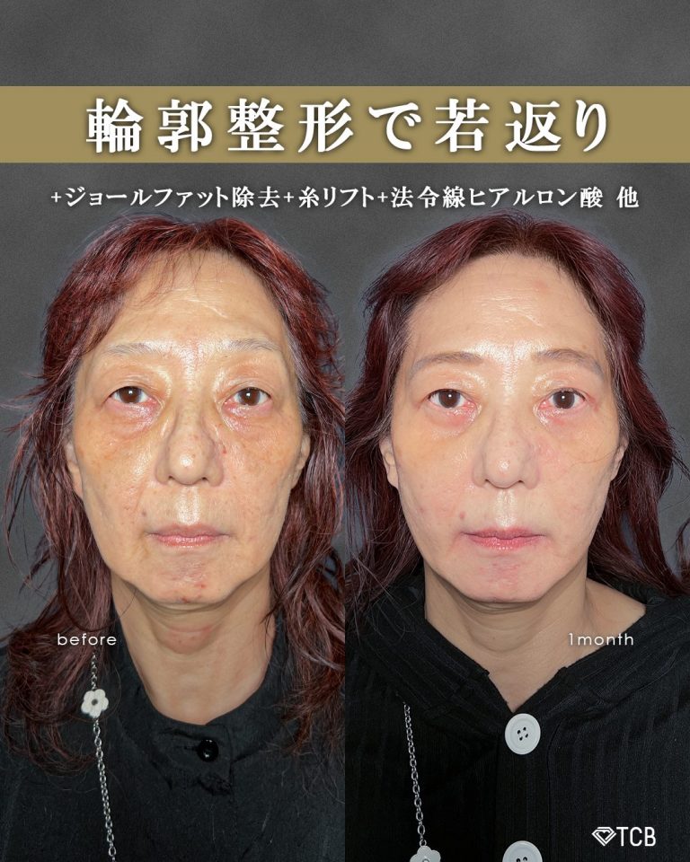 ジョールファット除去(担当医:富田 秀鷹 医師)の症例写真1