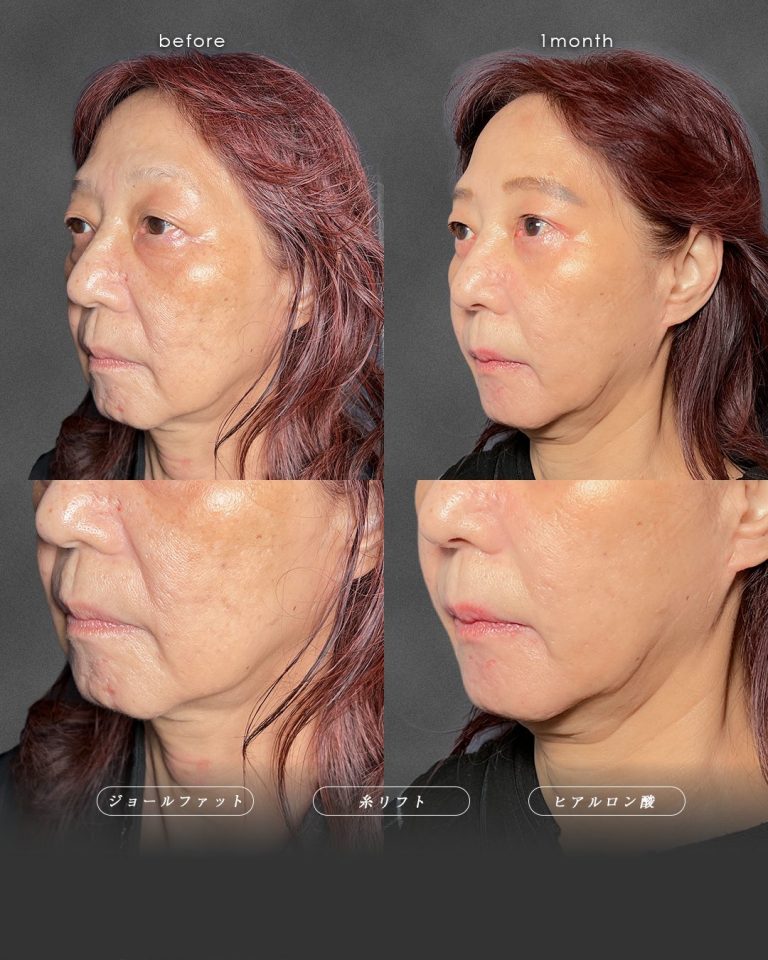 ジョールファット除去(担当医:富田 秀鷹 医師)の症例写真2