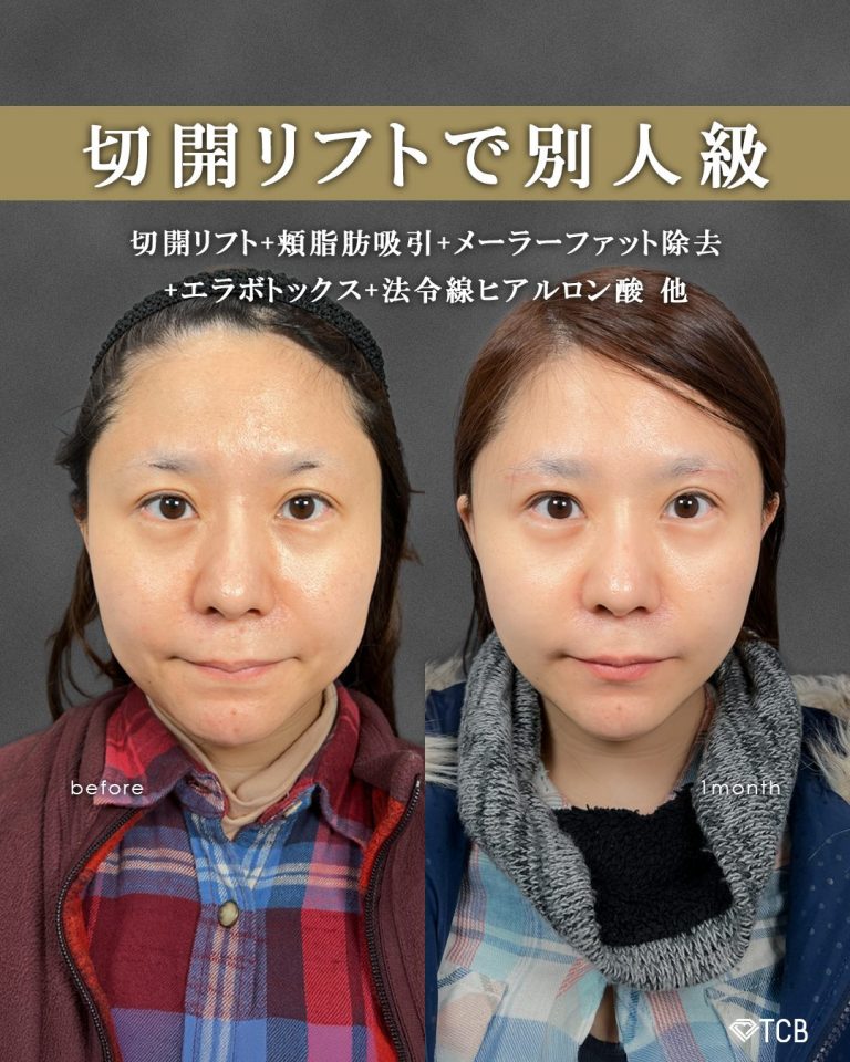 切開リフト（フェイスリフト・ミニフェイスリフト）(担当医:富田 秀鷹 医師)の症例写真1