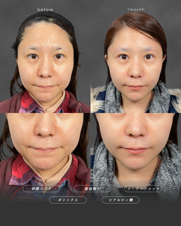 切開リフト（フェイスリフト・ミニフェイスリフト）(担当医:富田 秀鷹 医師)の症例写真3