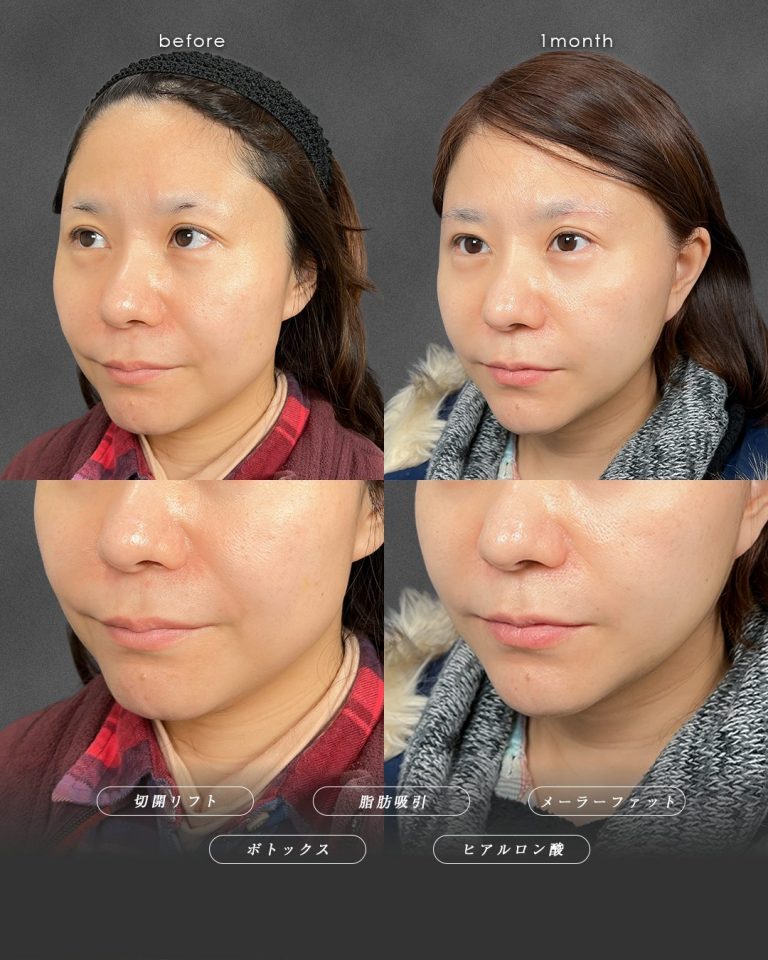 切開リフト（フェイスリフト・ミニフェイスリフト）(担当医:富田 秀鷹 医師)の症例写真2