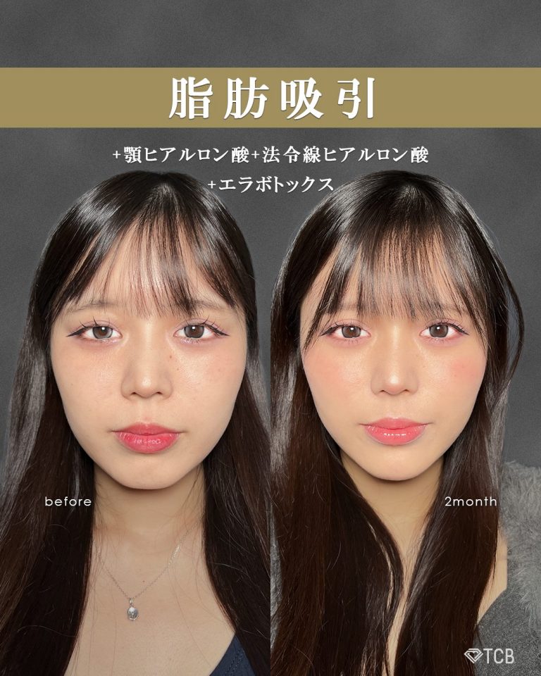 顔の脂肪吸引(担当医:富田 秀鷹 医師)の症例写真1