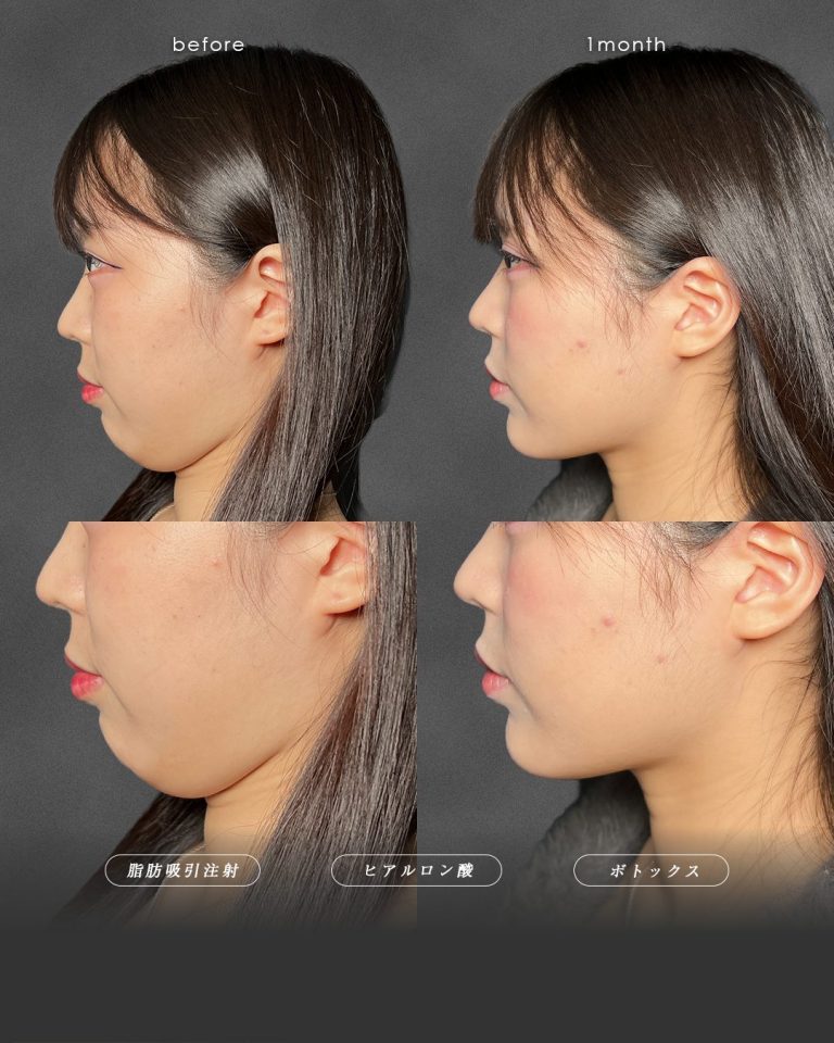 顔の脂肪吸引(担当医:富田 秀鷹 医師)の症例写真2