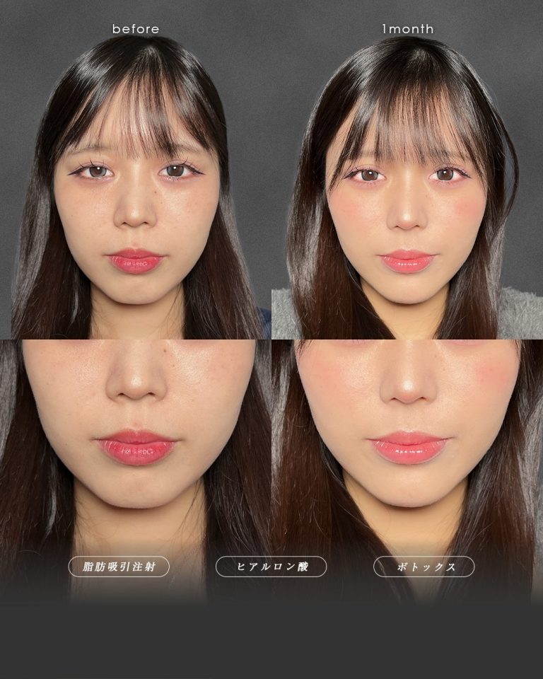 顔の脂肪吸引(担当医:富田 秀鷹 医師)の症例写真3