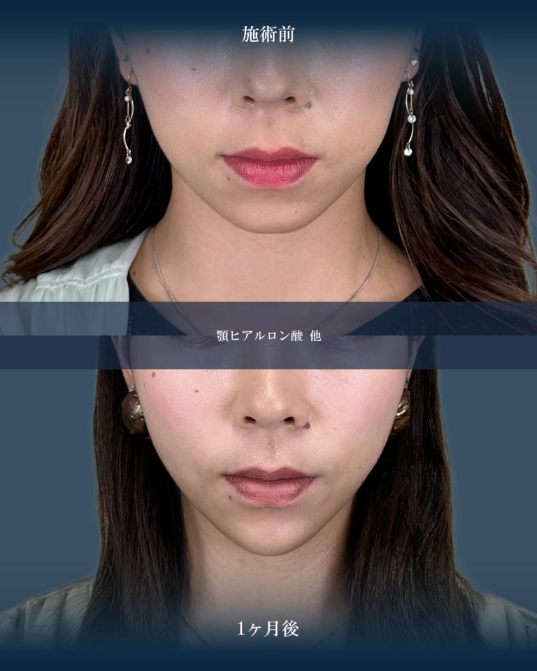 顎（あご）のヒアルロン酸注射(担当医:大見 貴秀 医師)の症例写真1