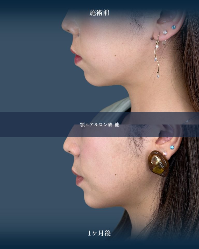 顎（あご）のヒアルロン酸注射(担当医:大見 貴秀 医師)の症例写真2