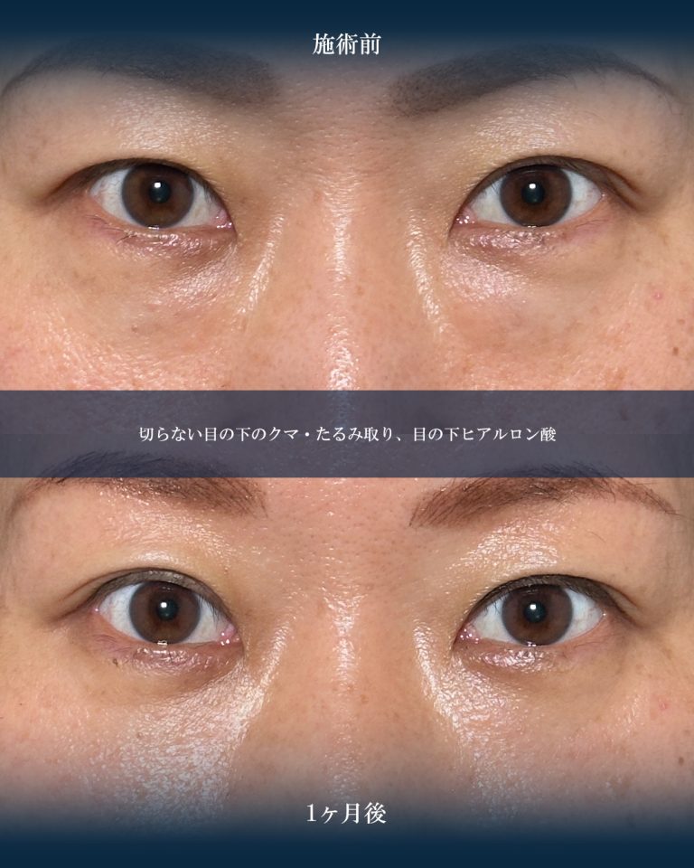 切らない目の下のクマ取り・目の下のたるみ（ふくらみ）取り(担当医:大見 貴秀 医師)の症例写真1