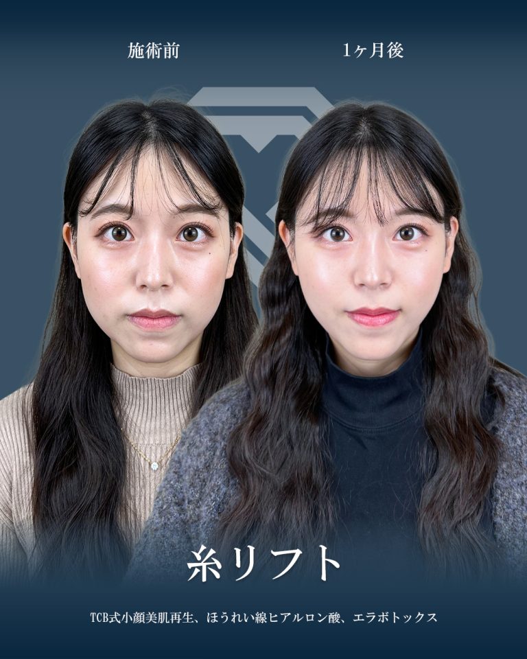 小顔美肌再生（リフトアップ）(担当医:大見 貴秀 医師)の症例写真1